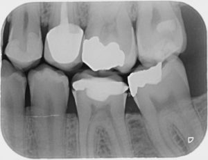 Bitewing dental X-ray showing upper and lower molars and premolars, revealing multiple white dental fillings.
