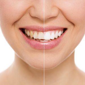 cosmetic dental bonding