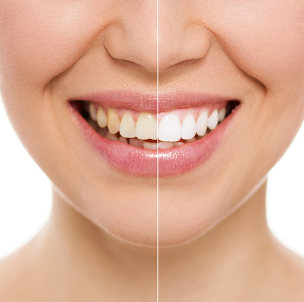 Teeth bonding treatment