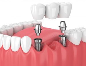Dental Bridges
