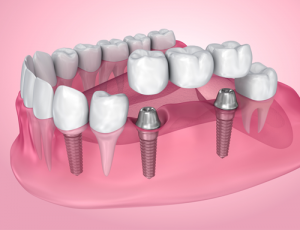 Diagram illustrating a three-unit dental bridge permanently cemented onto two integrated dental implants.