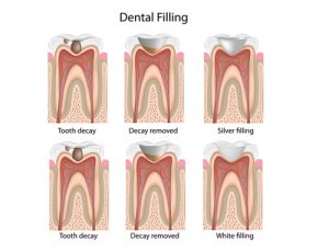 best tooth filling in corona