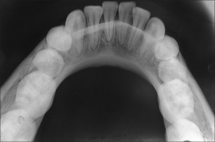 Occlusal X-Ray - X-Ray that Scans the Arch of a Whole Row of Teeth