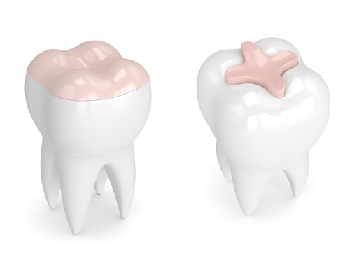 Dental Inlays / Onlays (indirect fillings)