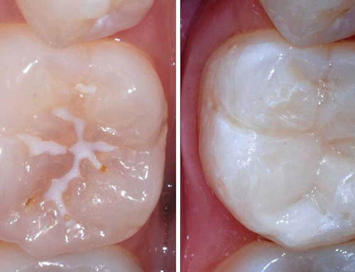 Sealants for Preventing Tooth Decay