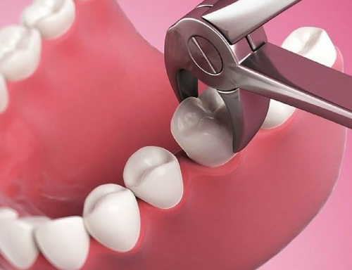 Tooth Extraction - A Procedure to Remove a Tooth from the Gum Socket.