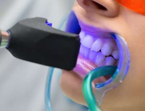 Close-up of teeth being professionally whitened with a blue LED curing light and a cheek retractor.