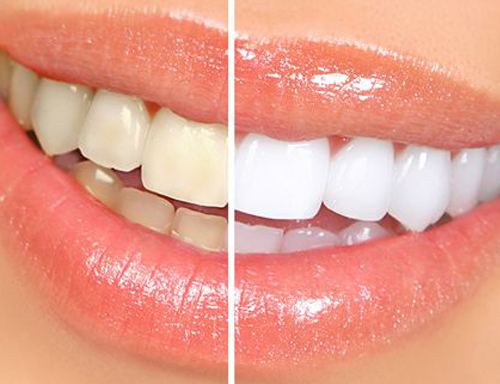 Removes Stubborn Teeth Stains with Zoom Teeth Whitening