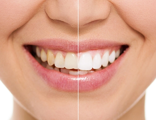Split image comparing yellow teeth to white teeth.