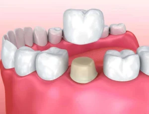 3D diagram showing a dental crown being placed onto a tooth that has been filed down.
